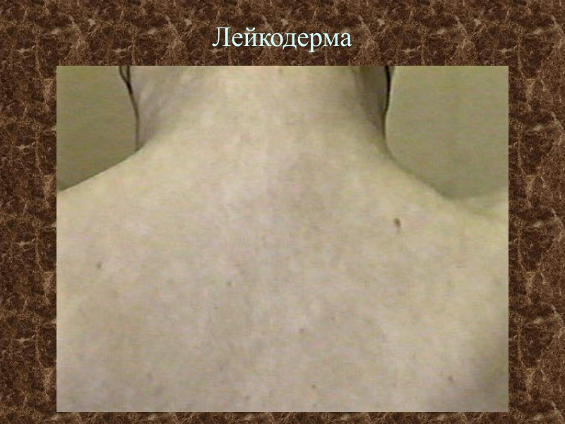 Лейкодерма